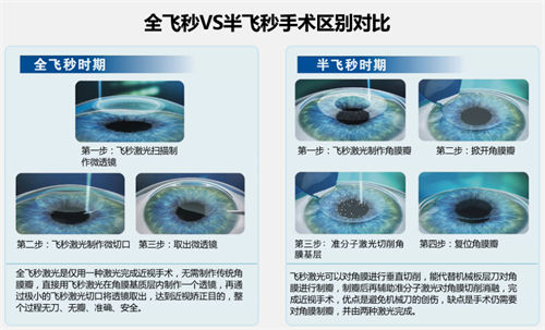 全飞秒与半飞秒，激光近视矫正技术的深度解析